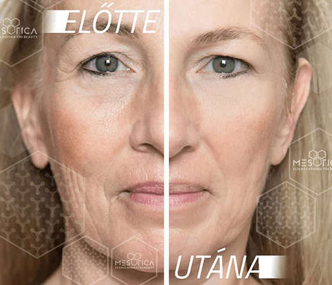 Botox kezelés előtte utána képek — botox kezelés